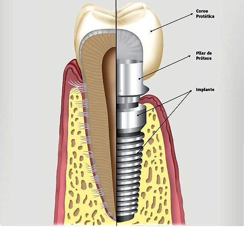 Dente X Implante